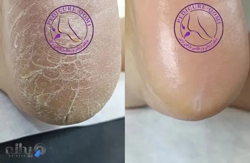 پدیکور قم|فاطمهمحمدی