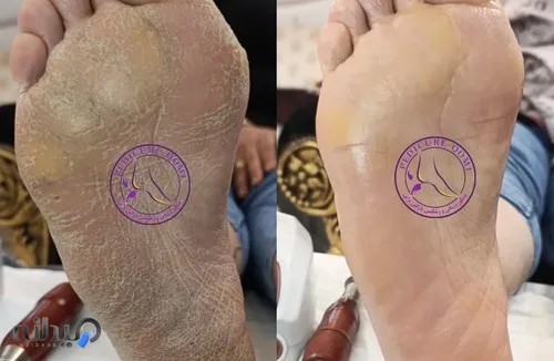 پدیکور قم|فاطمهمحمدی