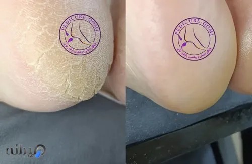 پدیکور قم|فاطمهمحمدی