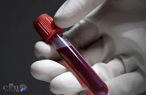 فصد خون خواجو ( فلبوتومی)