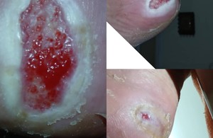 متخصص وکیوم تراپی زخم