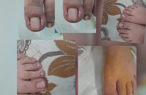 متخصص وکیوم تراپی زخم