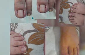 متخصص وکیوم تراپی زخم