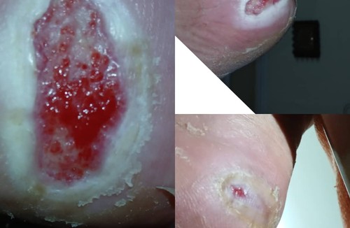 متخصص وکیوم تراپی زخم