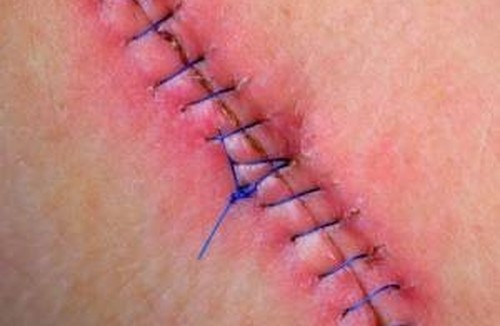 متخصص زخم و جراحی کوچک