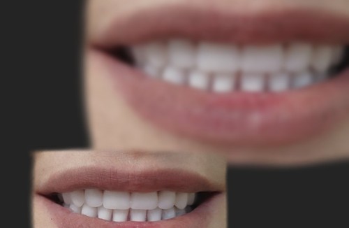 دندانسازی نیودنت