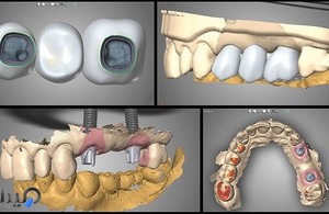 دندانسازی تخصصی آل سرام