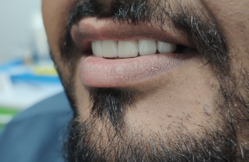 دندانسازی تخصصی آل سرام