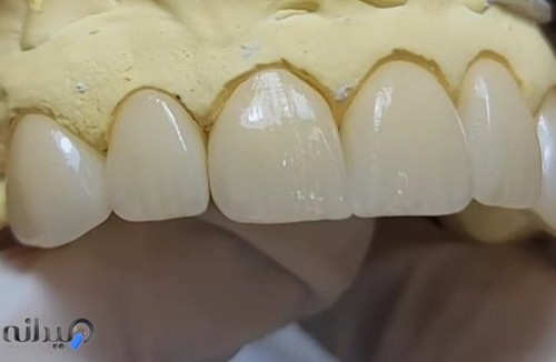 دندانسازی تخصصی آل سرام