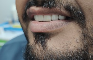 دندانسازی تخصصی آل سرام