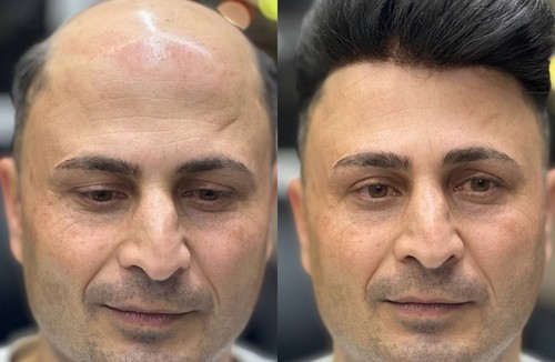 کلینیک پروتز موی یاسین بیاتی