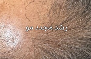 اسکالپ تراپی عارفه باقری