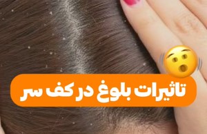 اسکالپ تراپی عارفه باقری