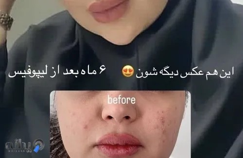 باکال فت ریمووال