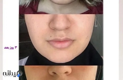 باکال فت ریمووال