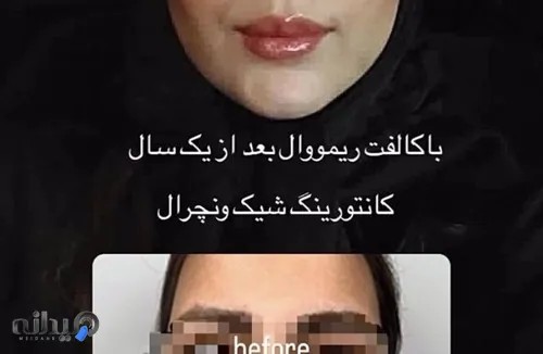 باکال فت ریمووال