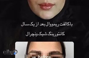 باکال فت ریمووال