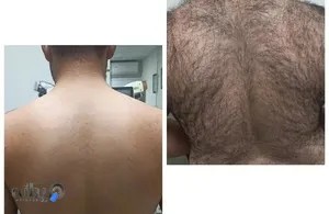 بهترین کلینیک لیزر بوکان