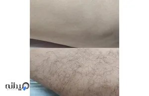 بهترین کلینیک لیزر بوکان