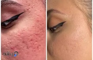 بهترین کلینیک لیزر بوکان