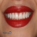 دکتر فروغ فدوی متخصص زیبایی طراحی لبخند لامینیت کامپوزیت ونیر