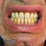 دندانسازی کشمیری