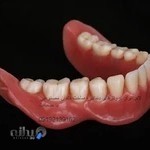 لابراتوار دندانسازی دندان مصنوعی ژله ای جایگزین ایمپلنت لمینیت کامپوزیت نایت گارد