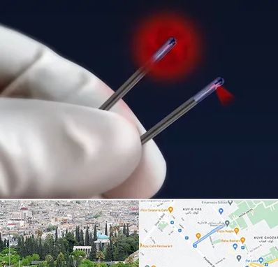 جراحی سینه با لیزر در محلاتی شیراز