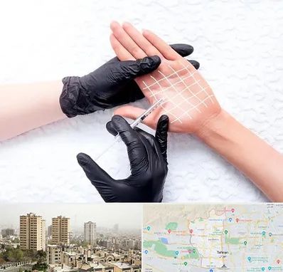 تزریق بوتاکس کف دست در منطقه 5 تهران 