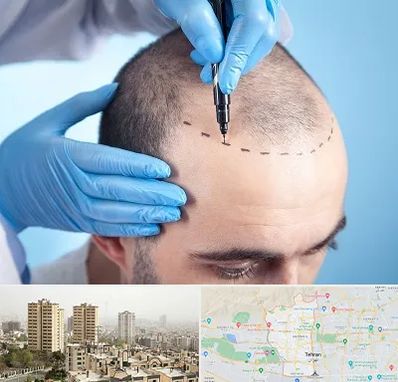 دکتر کاشت مو در منطقه 5 تهران 