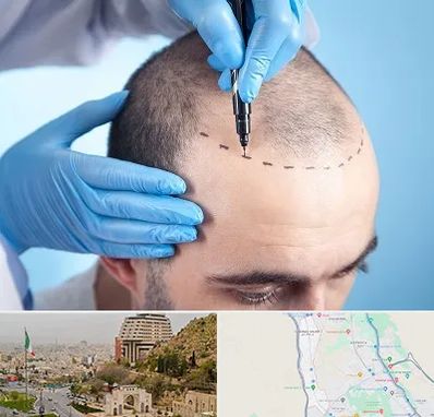 دکتر کاشت مو در فرهنگ شهر شیراز