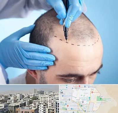 دکتر کاشت مو در منطقه 14 تهران 