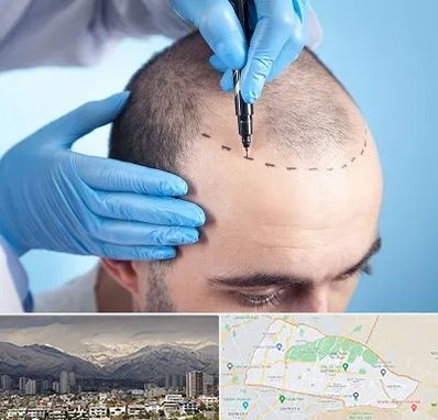 دکتر کاشت مو در منطقه 4 تهران 