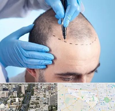 دکتر کاشت مو در منطقه 18 تهران 