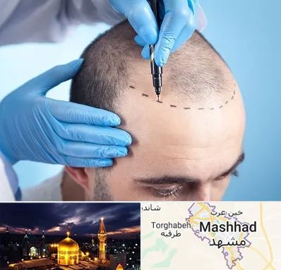 دکتر کاشت مو در مشهد
