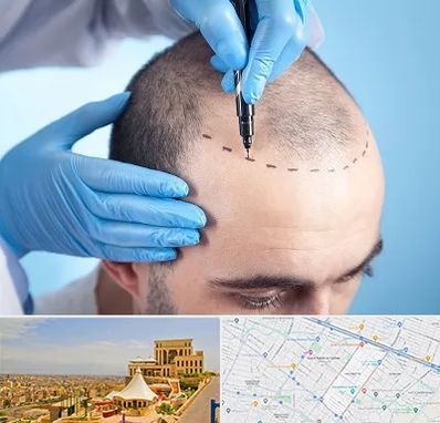 دکتر کاشت مو در هاشمیه مشهد