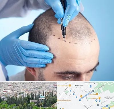 دکتر کاشت مو در محلاتی شیراز