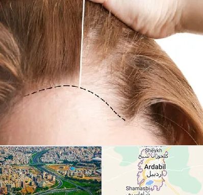 کاشت مو برای خانمها در اردبیل