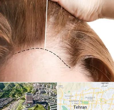 کاشت مو برای خانمها در شمال تهران 