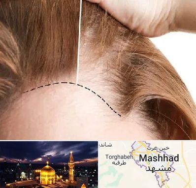 کاشت مو برای خانمها در مشهد