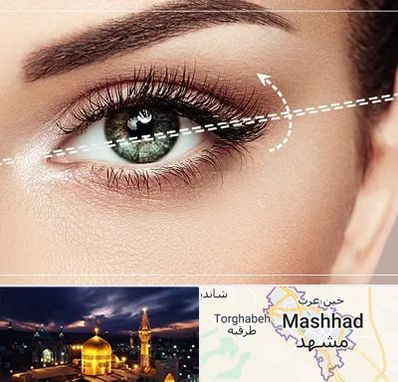 جراحی چشم گربه ای در مشهد