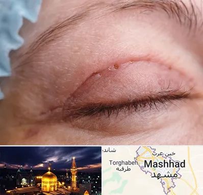 جراح پلک در مشهد