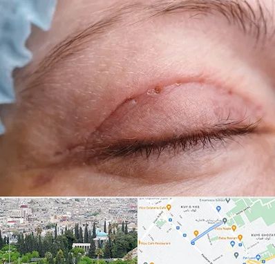 جراح پلک در محلاتی شیراز