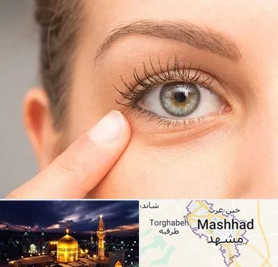 جراح پف چشم در مشهد