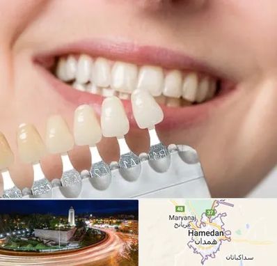 مرکز کامپوزیت دندان در همدان