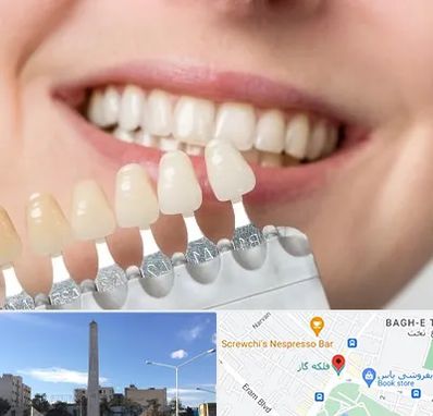 مرکز کامپوزیت دندان در فلکه گاز شیراز
