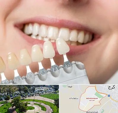 مرکز کامپوزیت دندان در مهرشهر کرج