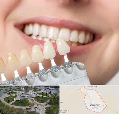 مرکز کامپوزیت دندان در ورامین