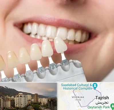 مرکز کامپوزیت دندان در زعفرانیه