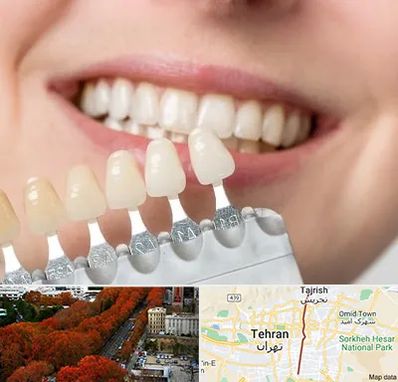 مرکز کامپوزیت دندان در ولیعصر